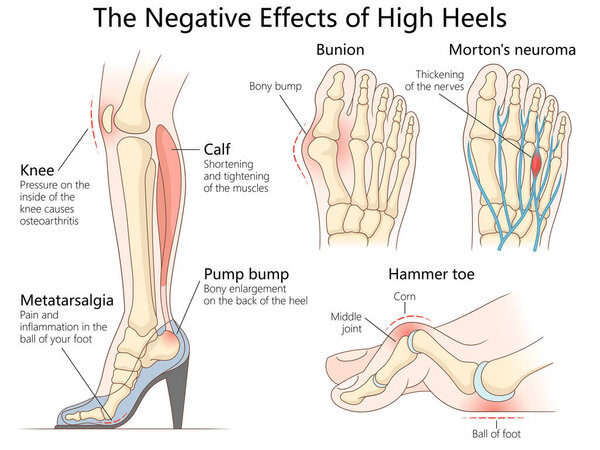 проблемы со здоровьем, вызванные высокими каблуками, включая мозоли, боль в ноге, боль в колене и диаграмму напряжения мышц голени, нарисованную вручную схематическую векторную иллюстрацию. Образовательная иллюстрация