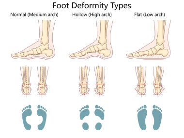 Ayak deformasyonu tipleri, normal kemer, çukur yüksek kemer, ve düz kemer, anatomik ve ayak izi görünümleri şematik vektör çizimi. Tıp bilimi eğitimsel illüstrasyon