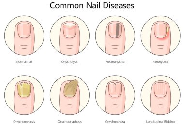 Tırnak hastalıkları, onyeliz, melanonychia, paronychia, onychomycosis, ve diğer tırnak anormallikleri şematik vektör çizimi gibi. Tıp bilimi eğitimsel illüstrasyon