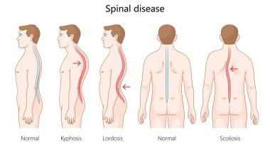 Omurga düzensizliği, kifoz, lordosis ve skolyoz dahil olmak üzere omurga düzensizlikleri anormal eğriler ve el çizimi konum diyagramı vektörü gösteriyor. Tıp bilimi eğitimsel illüstrasyon