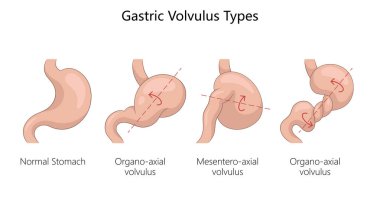 Gastrik volvulus türleri, normal mide, organo-eksen volvulus, mezenteryal volvulus ve döner eksenli el diyagramı şematik raster çizimi. Tıp bilimi eğitimsel illüstrasyon