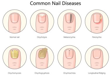 Tırnak hastalıkları, onyeliz, melanonychia, paronychia, onychomycosis ve diğer tırnak anormallikleri şematik raster çizimi gibi. Tıp bilimi eğitimsel illüstrasyon