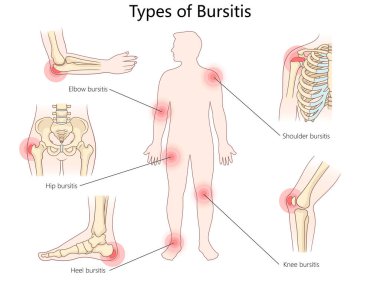 Dirsek, omuz, kalça, diz ve topuk gibi iltihaplı bursae konumu şematik raster çizimi şeması içeren bursitis tipleri. Tıp bilimi eğitimsel illüstrasyon