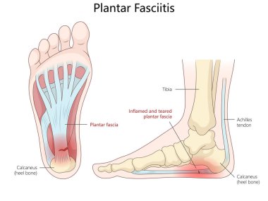 Plantar fasiitin anatomik diyagramı, plantar fasianın iltihaplanmasını ve yırtılmasını gösteriyor, topuk ağrısı ve ayak yapısı diyagramı el çizimi çizimi. Tıp Bilimi Eğitimi