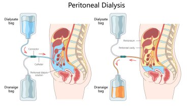 Periton diyalizinin nasıl işlediğini, kateter yerleştirme, diyaliz girişi ve periton boşluğu diyagramından elde çizilmiş şematik vektör çizimi dahil. Tıp Bilimi Eğitimi