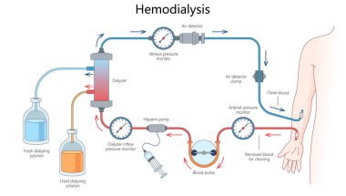 Diyalizör, kan pompası, basınç monitörleri ve diyaliz çözeltisi şematik vektör çizimi gibi etiketli parçalarla hemodiyaliz süreci. Tıp bilimi eğitimsel illüstrasyon