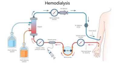 Diyalizör, kan pompası, basınç monitörleri ve diyaliz çözeltisi şematik raster çizimi gibi etiketli parçalarla hemodiyaliz süreci. Tıp bilimi eğitimsel illüstrasyon
