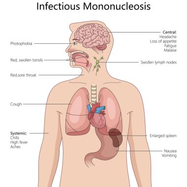 Bulaşıcı mononükleozun vücudu nasıl etkilediği, sistemik, solunum, sindirim sistemi ve nörolojik semptomlar dahil, el yapımı şematik raster. Tıp bilimi eğitimsel illüstrasyon