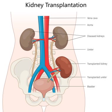 Böbrek ve üreterin insan vücuduna yerleştirilmesi hastalıklı böbreklerin ve ana kan damarlarının el çizimi şematik vektörün yanına. Tıp bilimi eğitimsel illüstrasyon