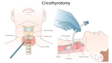 Krikotirominin anatomik işaretleri ve cerrahi adımları, boyun ve nefes borusu diyagramını içeren acil bir hava yolu prosedürü el çizimi şematik vektör çizimi. Tıp Bilimi Eğitimi
