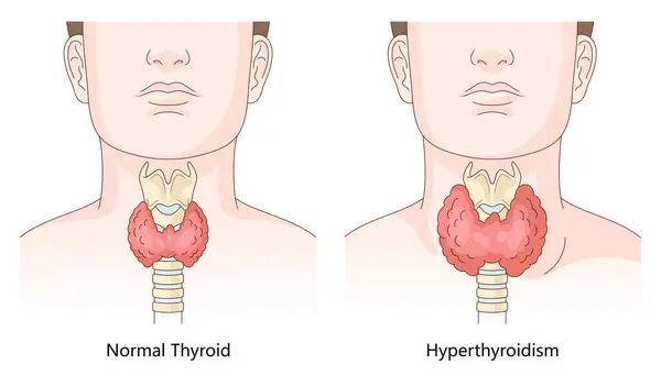 Diferencia entre una glándula tiroides sana y una tiroides agrandada afectada por el hipertiroidismo para uso educativo diagrama dibujado a mano ilustración de trama esquemático. Ciencias médicas educativas.