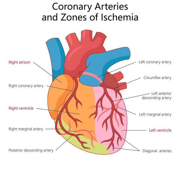 коронарные артерии и зоны ишемии в сердце человека, идеально подходит для кардиологического образования и здравоохранения эталонной диаграммы ручной работы схематические растровые. Образовательная иллюстрация