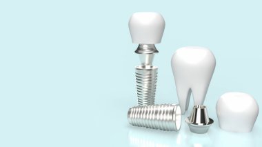 Diş implantları tipik olarak titanyum ya da titanyum alaşımı gibi biyouyumlu malzemelerden yapılır. Titanyum, insan vücuduyla mükemmel uyumluluğu ve reddedilme riski nedeniyle tercih edilir..