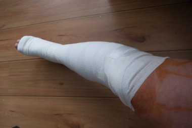 injured leg in a bandage after surgery