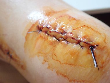 detail of stitches on a scar on a knee clipart