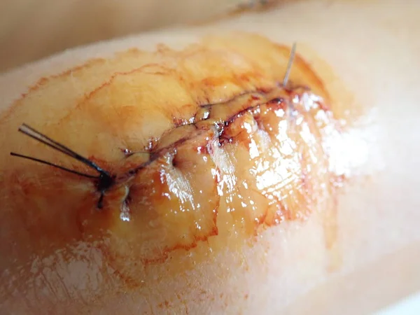 Detail Jahitan Pada Bekas Luka Lutut Stok Foto