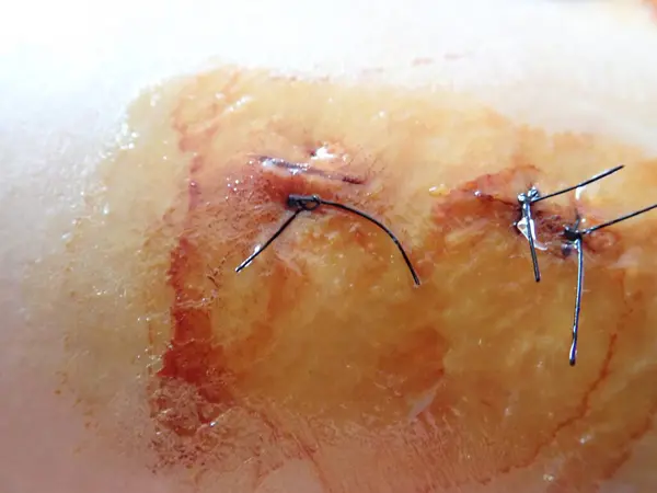 Detail Jahitan Pada Bekas Luka Lutut Stok Foto