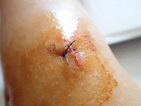 Detail Jahitan Pada Bekas Luka Lutut Stok Gambar