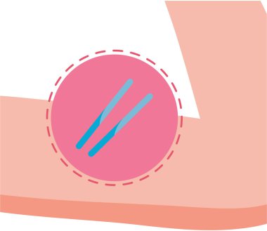 Doğum kontrol implantı tasarım illüstrasyon vektörü