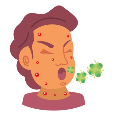 Maymun hastalığı geçiren hasta adam izole edilmiş.