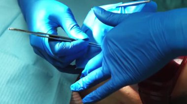 Bir cerrahi müdahalede bulunan ellerin detaylı bir yakın çekimi hem hassasiyet hem de hareket kabiliyeti gösteriyor.