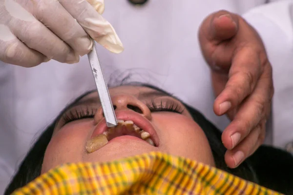 stock image Dentists file the teeth of a participant in the tooth-cutting procession or Mepandes tradition at the Giri Kusuma Temple Pasraman, Bogor City, West Java, Indonesia, on July 9 2023