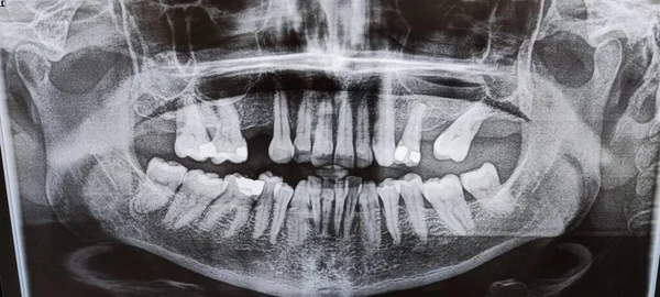 Röntgenbild Des Menschlichen Schädels Krankenhaus — Stockfoto
