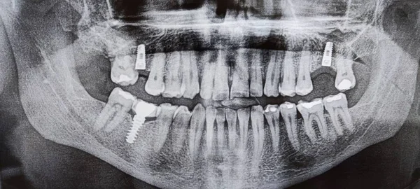Рентгенівське Зображення Людського Хребта — стокове фото