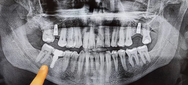 Рентгенівський Знімок Людського Тіла — стокове фото