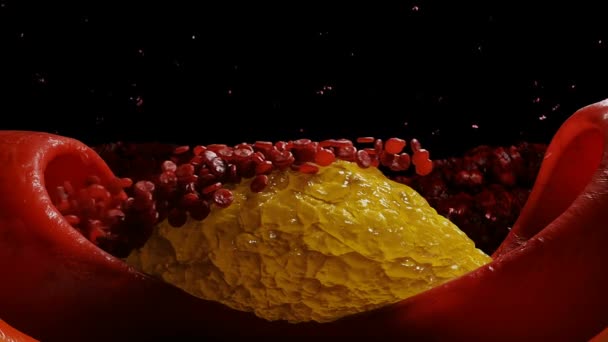 Blood Stream Cholesterol Plaque Thrombus Health Harm Concept Human Body — Stock Video