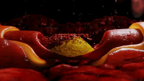 Corrente Sanguínea Placa Colesterol Trombo Conceito Danos Saúde Dentro Corpo — Vídeo de Stock