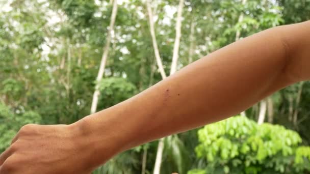 Muž Byl Kousnut Paže Komárem Jeho Kůže Byla Horkém Létě — Stock video