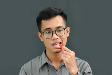Asian man has aphthous boils on his lips. clipart