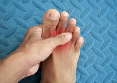 Gut hastalığından muzdarip bir adamın ayak parmakları, kırmızı ile işaretlenmiş acı veren bölge.