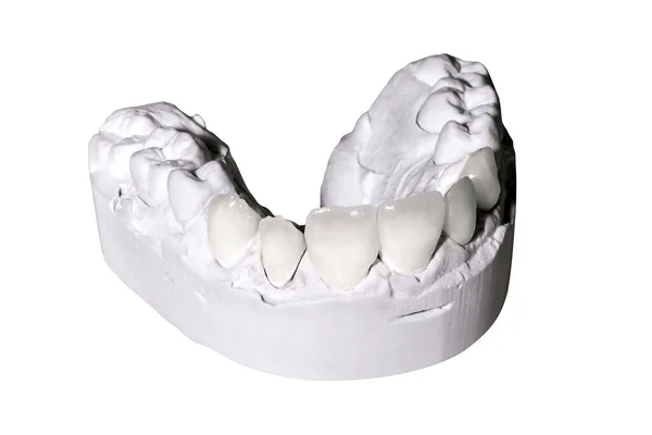 Fotografie Zubního Sádrovce Modely Izolované Bílém Pozadí — Stock fotografie