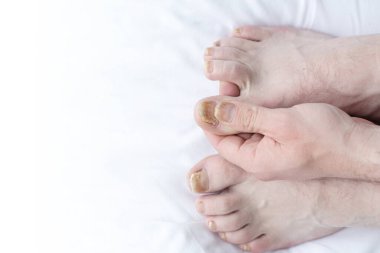 Tırnak mantarlı erkek tırnakları. Tırnak diplerinde mantar enfeksiyonu, onikomikozlu parmak. Bakım ve tedavi. Mantar yüzünden zarar görmüş tırnaklı bir ayağın yakın çekimi.