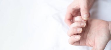 Tırnak mantarlı erkek tırnakları. Ellerde mantar enfeksiyonu, parmaklarda onikomikozis. Bakım ve tedavi. Mantar yüzünden zarar görmüş tırnaklı bir ayağın yakın çekimi.