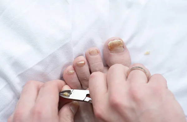 Male Cut Nails Nail Fungus Fungal Infection Nails Legs Finger — Fotografia de Stock
