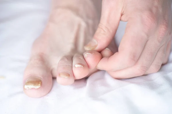 Male Cut Nails Nail Fungus Fungal Infection Nails Legs Finger — Fotografia de Stock