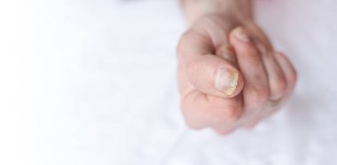 Tırnak mantarlı erkek tırnakları. Parmaklarındaki mantar enfeksiyonu ile onikomikozis. Bakım ve tedavi. Mantar yüzünden zarar görmüş tırnaklı bir ayağın yakın çekimi.