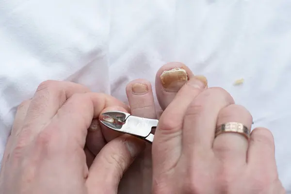 Männchen Schneiden Nägel Mit Nagelpilz Pilzinfektion Den Händen Finger Mit Stockbild