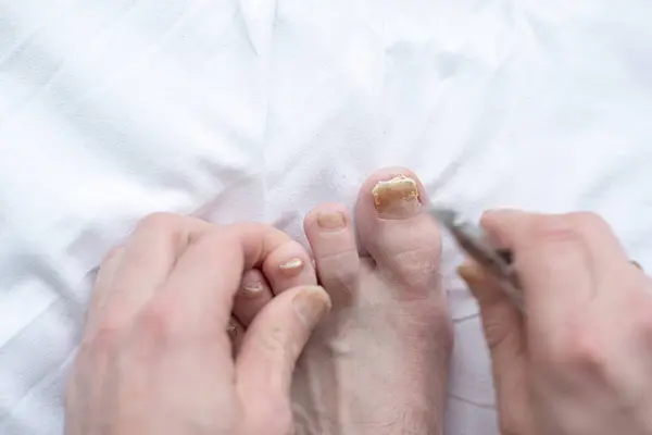 Männchen Schneiden Nägel Mit Nagelpilz Pilzinfektion Den Händen Finger Mit lizenzfreie Stockbilder