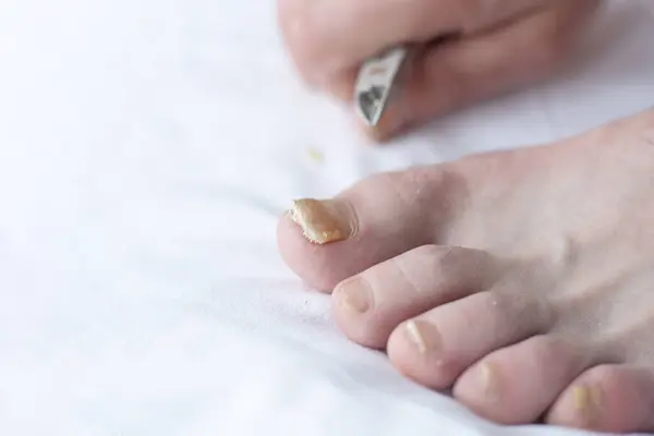 Männchen Schneiden Nägel Mit Nagelpilz Pilzinfektion Den Händen Finger Mit Stockbild