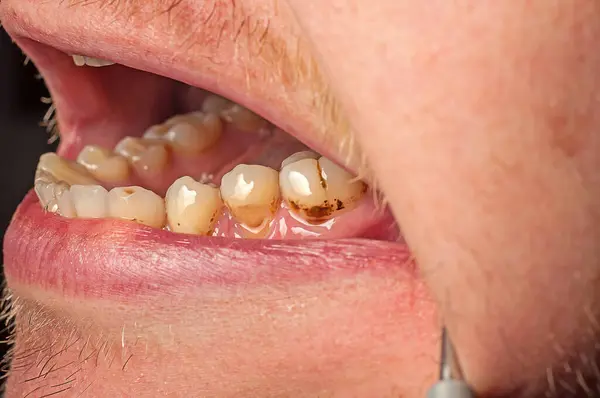 stock image Close-up of brown teeth with plaque and caries. The filling fell off the tooth.