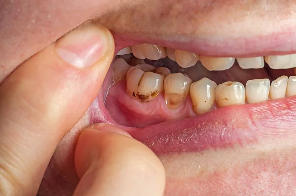 Κίτρινα Δόντια Πλάκα Από Κοντά Γέμιση Έπεσε Από Δόντι Royalty Free Εικόνες Αρχείου