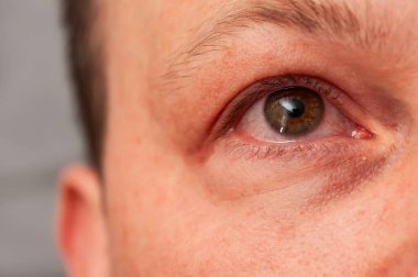 Gözüne yakın çekim, kızarıklık ve iltihap belirtileri, konjonktivit belirtileri. Göz, etkilenen bölgenin detaylarıyla birlikte görünür durumda..