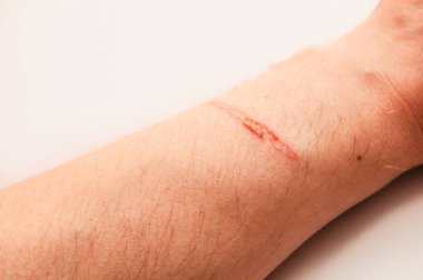 Bir insanın kolundaki deri yanığının yakın çekim görüntüsü. Yanık kırmızı ve iltihaplı görünüyor, iyileşme belirtileri gösteriyor..