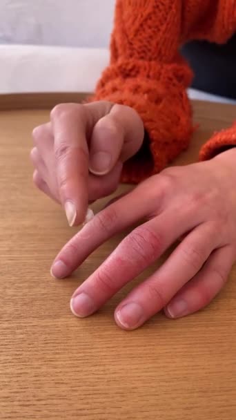 Beskär Kvinnlig Hand Med Chilblain Nära Öppen Vit Tub Medicinsk — Stockvideo