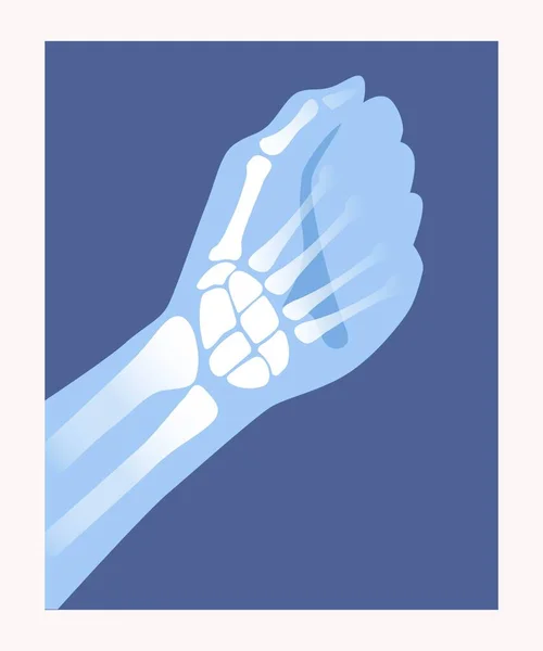 X光扫描 解剖海报与骨骼和关节的手 手掌和手指 人体骨骼的医学资讯 横幅的设计元素 白色背景上的卡通平面矢量插图 — 图库矢量图片