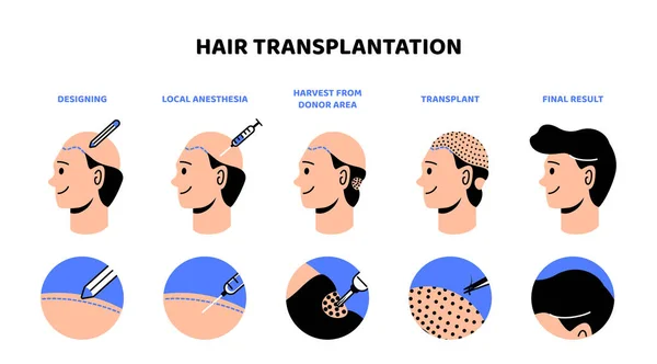 髪の移植プロセスのインフォグラフィック 医療美容トリートメント 脱毛症と戦う ドナー領域からの収穫と移植 漫画フラットベクトルイラスト — ストックベクタ